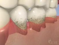 graphic showing gum disease in high point nc