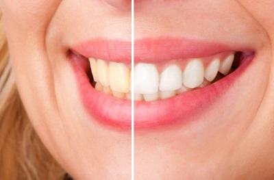 teeth whitening before and after | cosmetic dentistry high point
