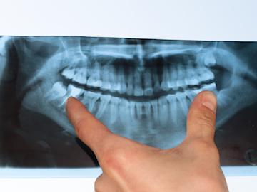 wisdom tooth removal high point