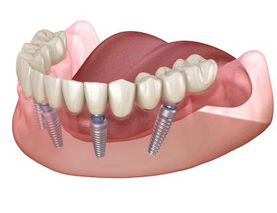 Dental implant in High Point NC