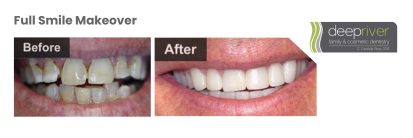 cosmetic dentist high point | before and after full smile makeover