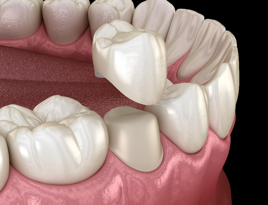 dental crowns high point