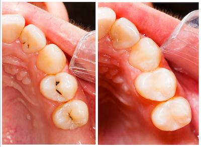 tooth-colored dental fillings high point | before and after