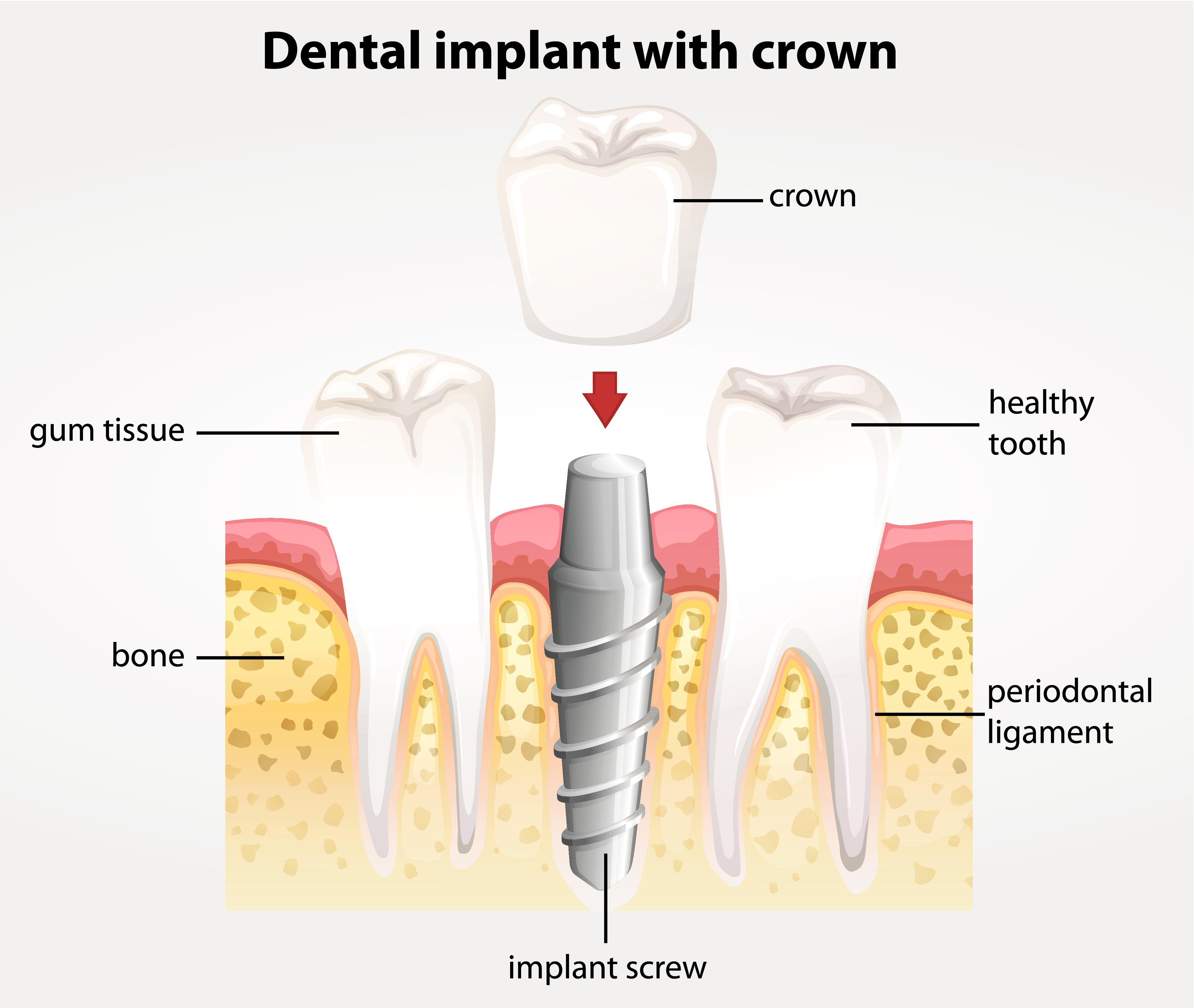 Dental Implants High Point NC