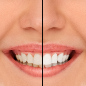 Teeth Whitening High Point NC