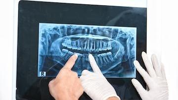 x-ray digital print of full mouth I deep river dentistry in high point, nc