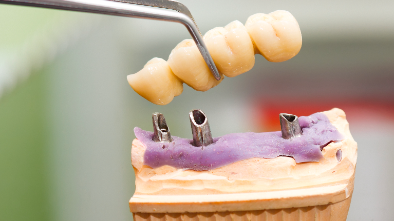 Crowns and Bridges High Point NC