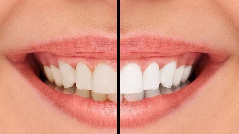 teeeth whitening high point nc