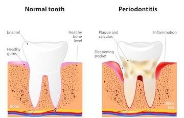 gum disease High Point NC