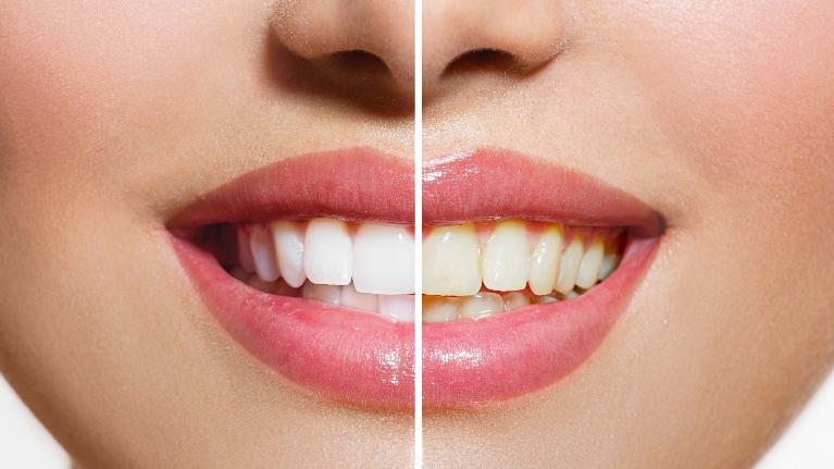 Teeth Whitening High Point NC