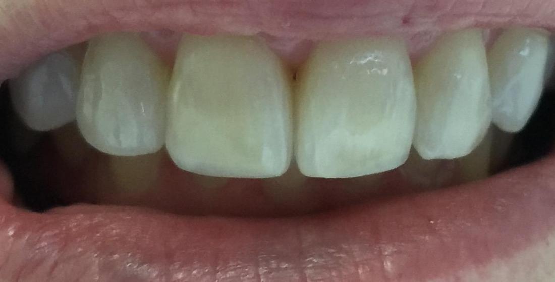 smile after invisalign treatment | dentist high point nc
