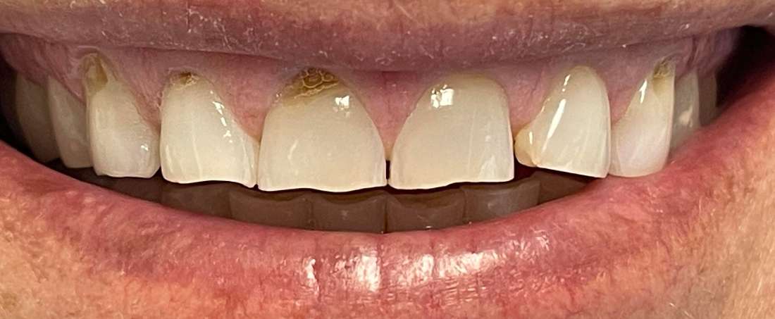 before cosmetic dentistry | high point dentist