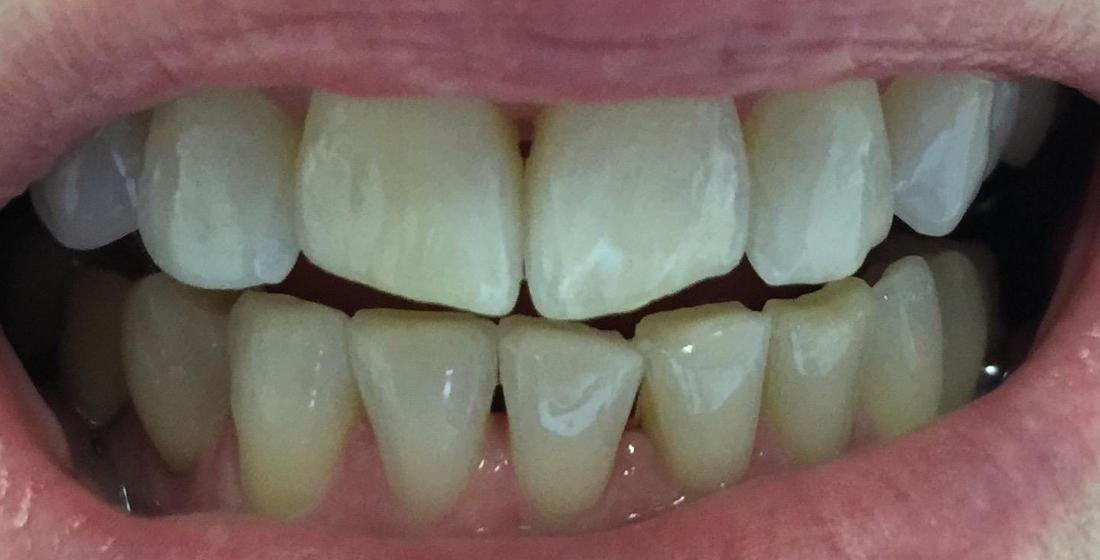smile before invisalign | dentist high point