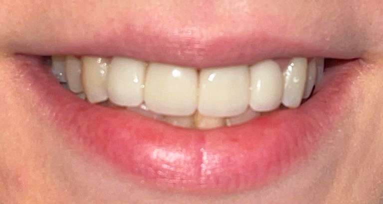 Patient after cosmetic bonding | dentist high point nc