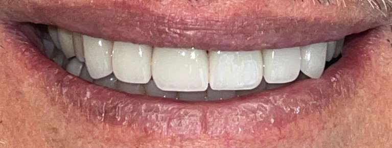 after cosmetic dentistry | high point dentist