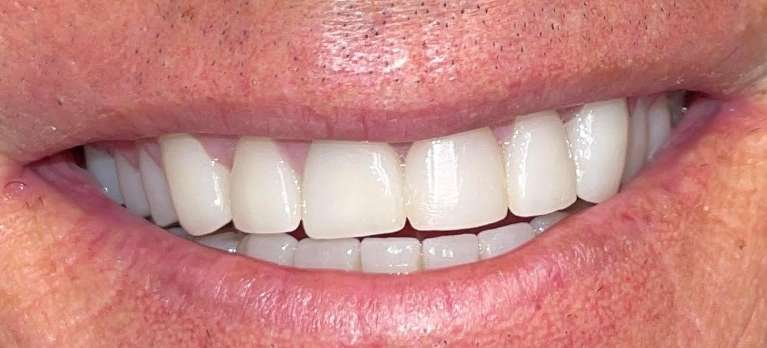 after photo of smile makeover | dentist high point