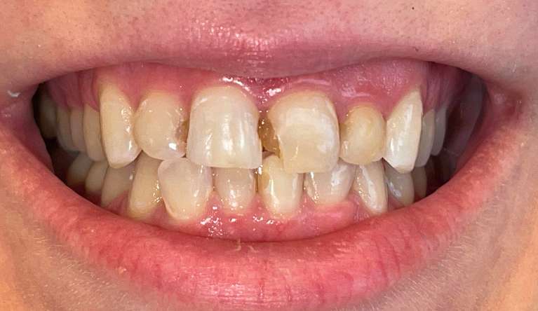 Patient before cosmetic bonding | dentist high point nc