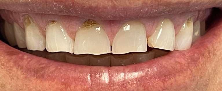 before cosmetic dentistry | high point dentist