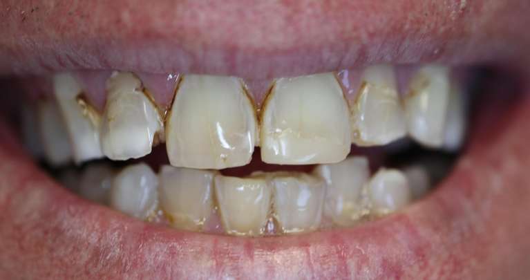 before photo of smile makeover | dentist high point